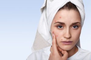 WHAT YOU NEED TO KNOW ABOUT ACNE TREATMENT IN DWARKA