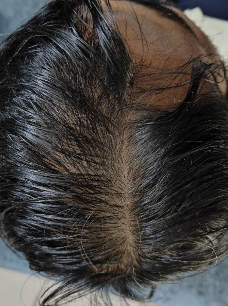 After PRP Hair Treatment