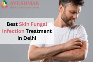 Best Skin Fungal Infection treatment in Delhi