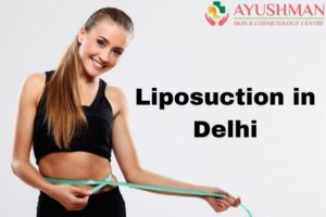 Liposuction in Delhi