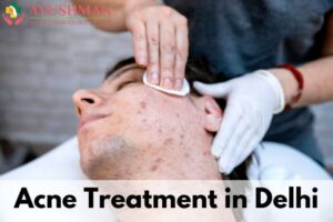 Acne Treatment in Delhi