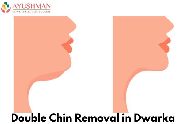 Double Chin Removal in Dwarka