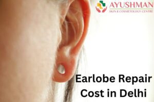 Earlobe Repair Cost in Delhi