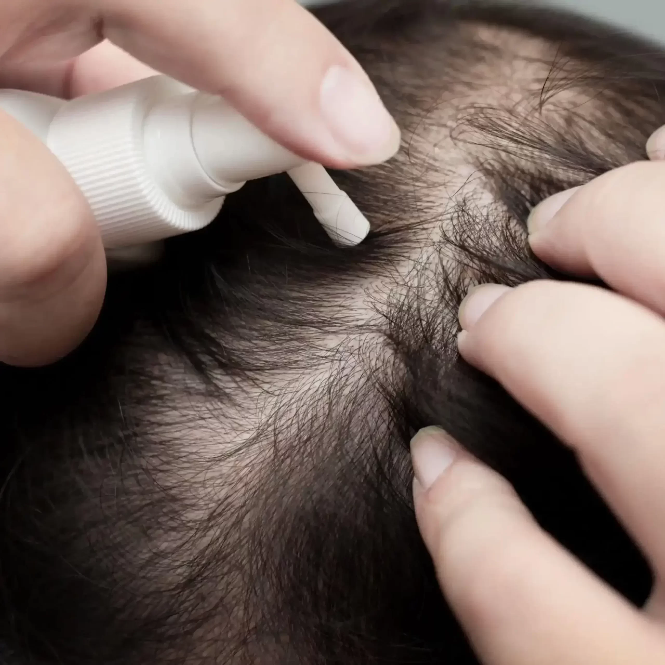 Hair loss treatment in Delhi