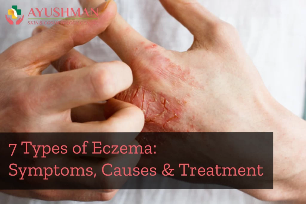 Types of Eczema