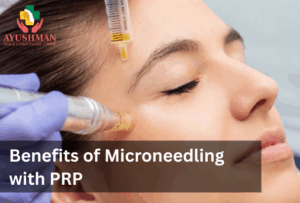 Benefits of Microneedling with PRP