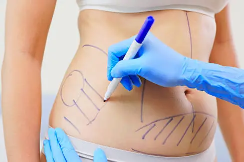 best Liposuction Surgery in Delhi