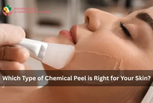 Which Type of Chemical Peel is Right for Your Skin?