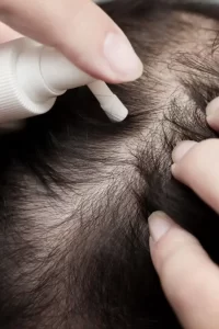 Hair loss treatment in Delhi Hair loss treatment in Delhi